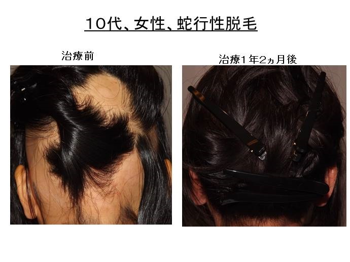 円形脱毛症　病院""